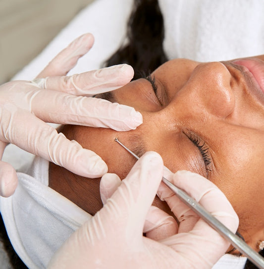 Extraction Methods for Inflamed & Noninflamed Acne