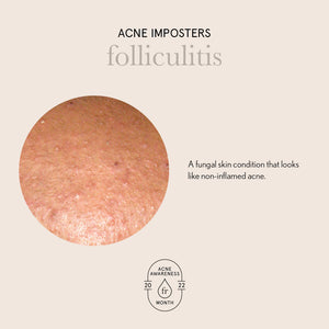 Acne Imposters- Folliculitis