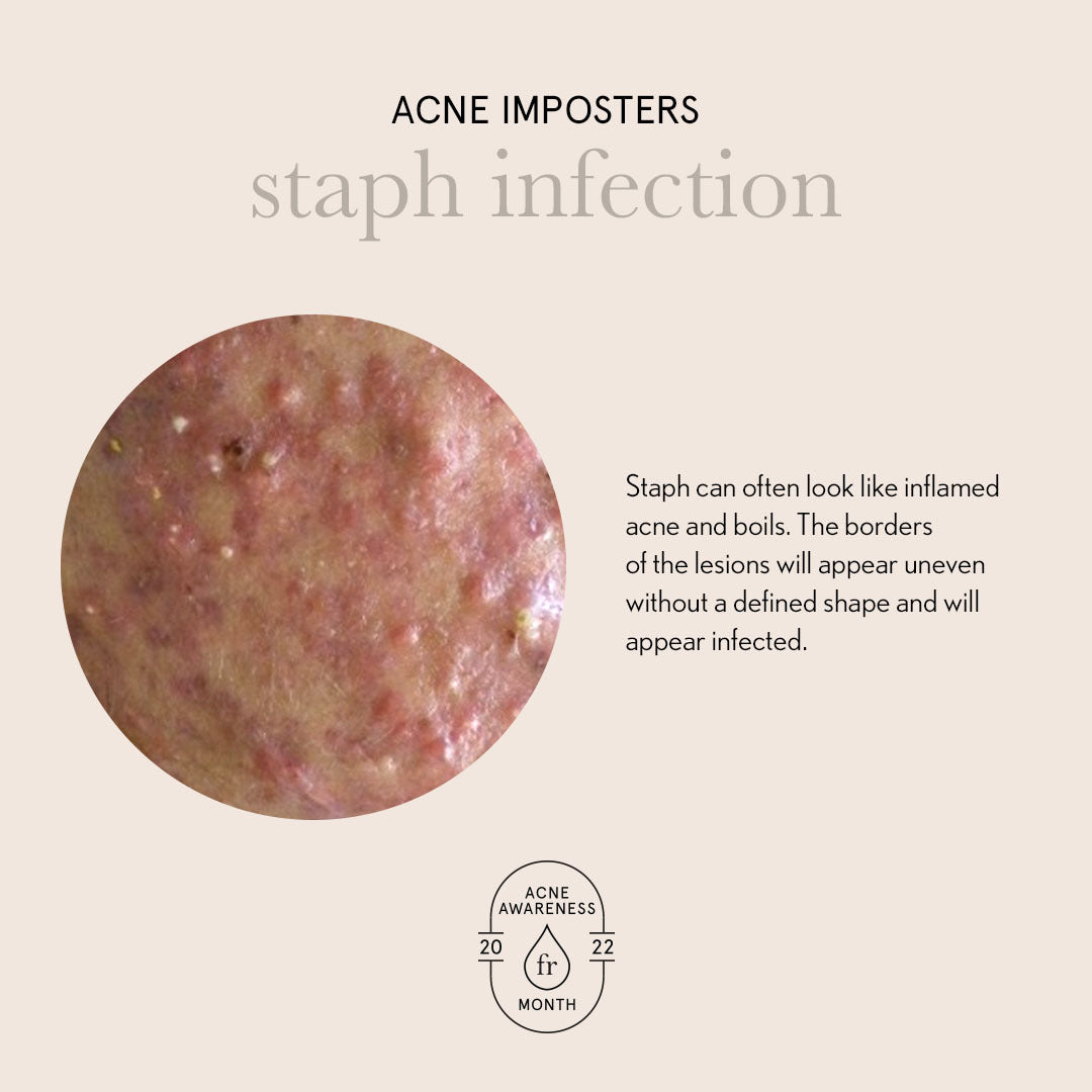 Acne Imposters- Staph Infection