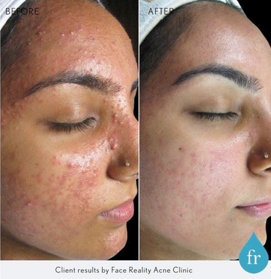 Identifying & Treating Acne Imposters