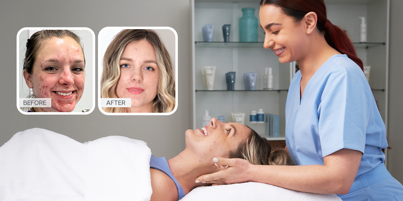 Acne Expert in treatment with a client. Clients before and after photos show clear skin progression