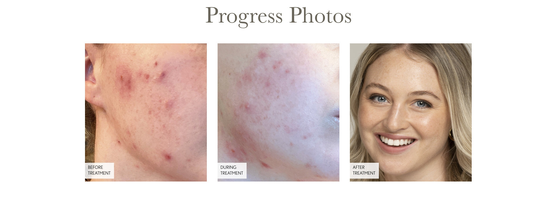 Progress Photos. A photo of Iskra's skin before Face Reality (moderate to severe inflamed acne), during treatment (moderate acne that is much less inflamed), and after treatment (clear skin, no blemishes). 